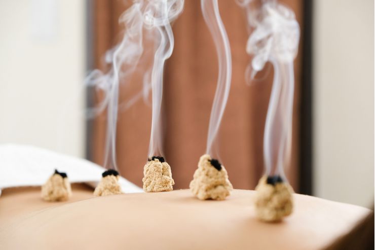 Acupuncture and Moxibustion