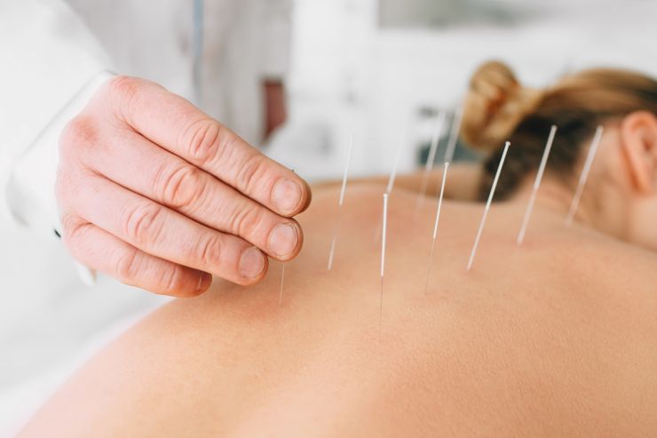 Acupuncture