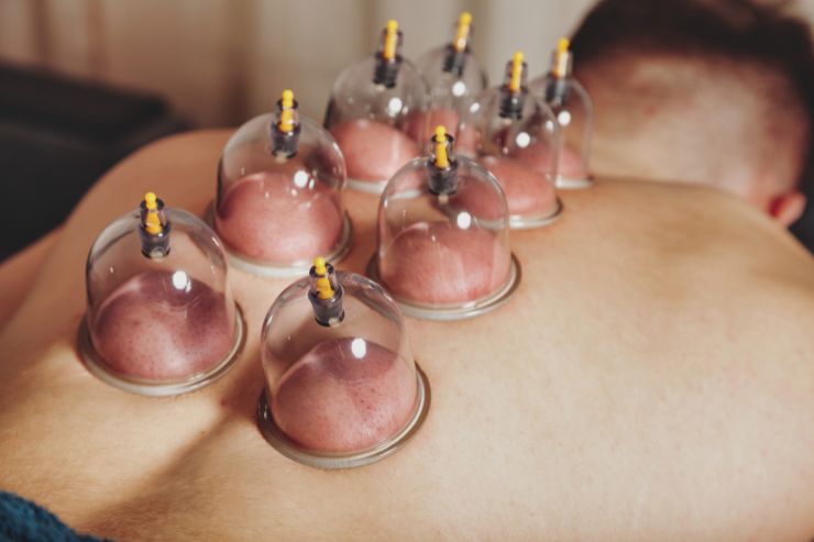 Cupping therapy